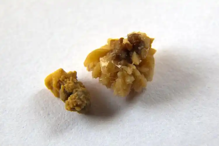 肾结石是什么颜色的石头图片_39健康网_精编内容