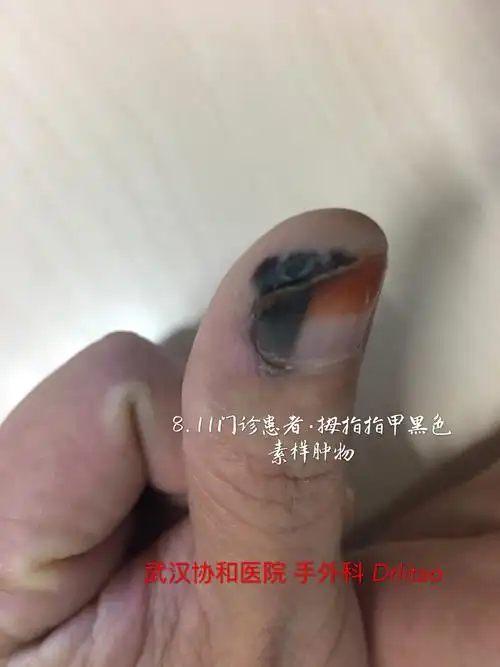 手指末端指甲发黑要高度警惕恶性黑色素瘤
