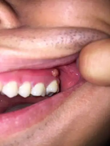 牙龈上长了一个包,去拍了片子,说是牙齿根部有阴影,然后用冰块冰,觉得