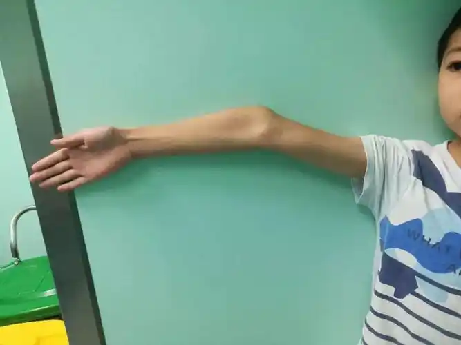 胳膊肘往里拐孩子这种情况不容忽视