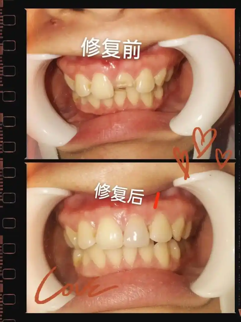 传统树脂补牙前后对比效果,看得见的美,还你自信笑容.#一口好 - 抖音