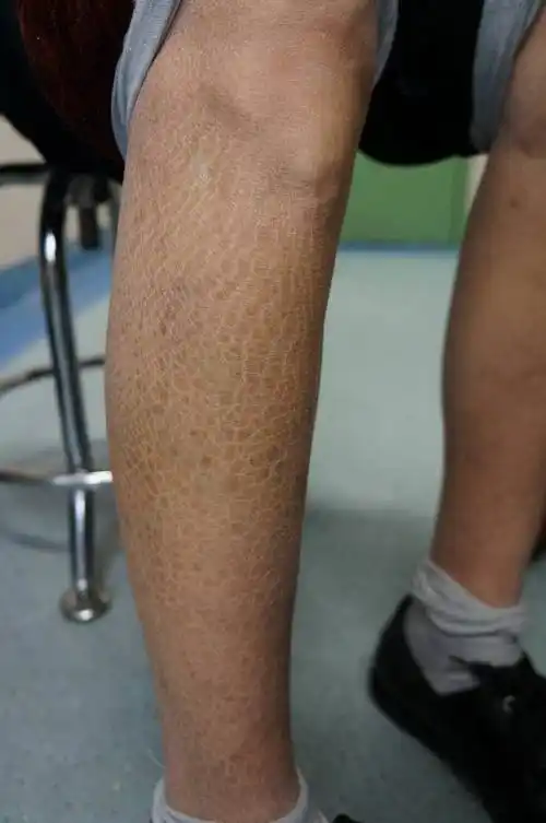 鱼鳞皮肤怎么办 鱼鳞皮肤怎么办?