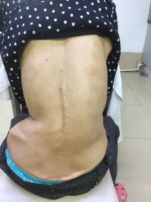 两侧肩部不等高;脊柱侧弯早期有以下常见临床表现吉林大学中日联谊