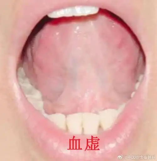 ①血虚  舌头下边儿的脉络特别的细,颜色很淡,甚至都看不到,说明血