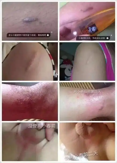 宝宝湿疹红屁股用春缇舍氧元素#小春#好吗?