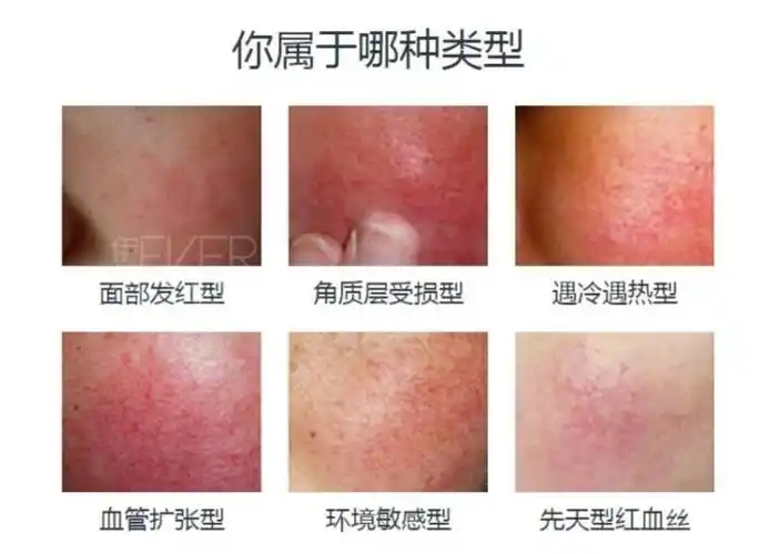 为什么脸上会有红血丝