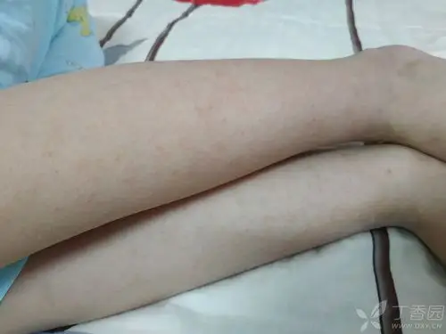 7岁孩子四肢皮肤红疹 [病例帖]