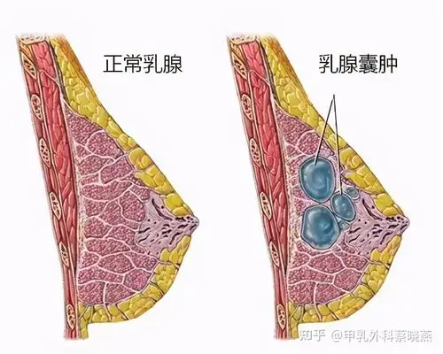 小的乳腺囊肿可以不用管,大的囊肿可以抽液治疗.