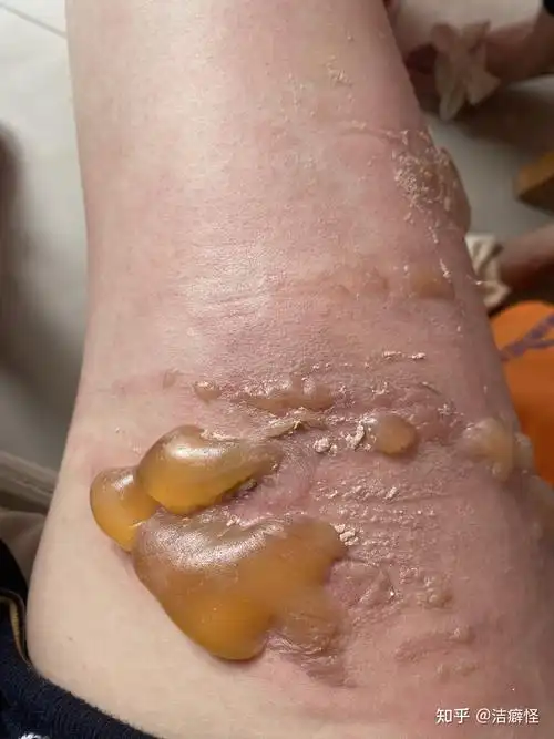 开水烫伤恢复过程更新中