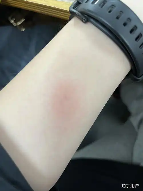 ppd皮试后这个样子怎么办? - 知乎