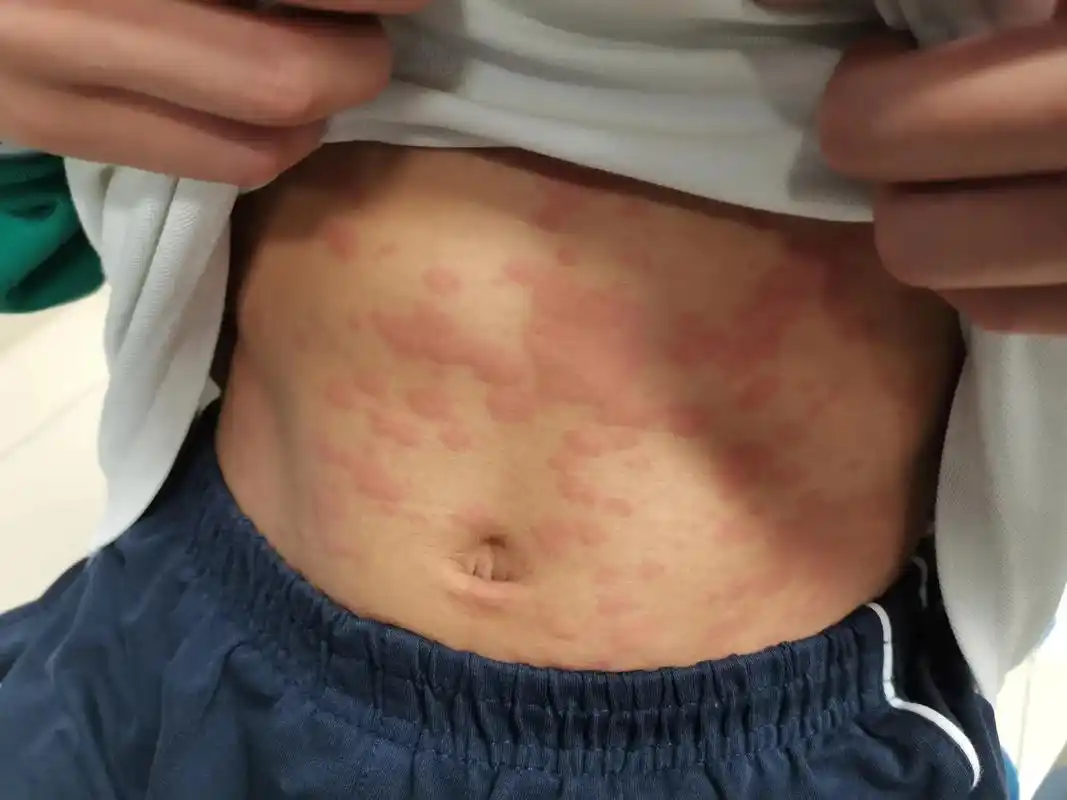 万能的抖音朋友圈,有什么民间偏方治疗荨麻疹的不?