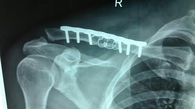 锁骨骨折术后内固定松动