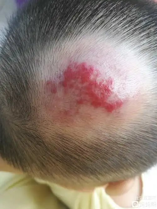 头顶部位血管瘤