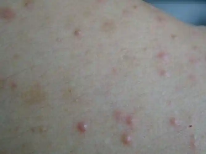 阴茎长毛囊炎的症状图片