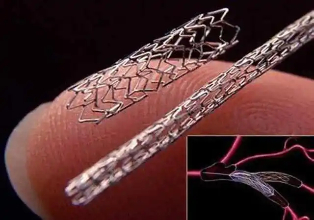 血管支架按类型主要可分为冠脉支架,脑血管支架,肾动脉支架,大动脉