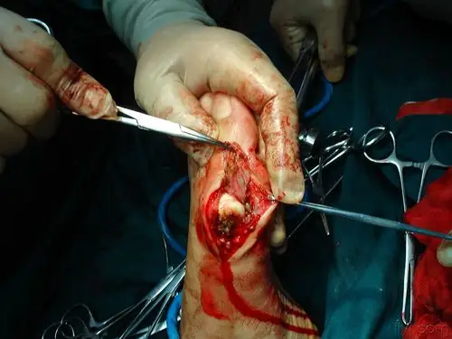 女性双足拇趾外翻治疗方法探讨