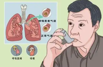 支气管哮喘会对身体健康造成哪些不良影响? - 知乎
