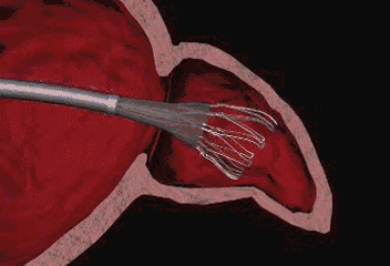 自2015年8月四川省科学城医院心血管内科开展首例射频消融术以来,先后