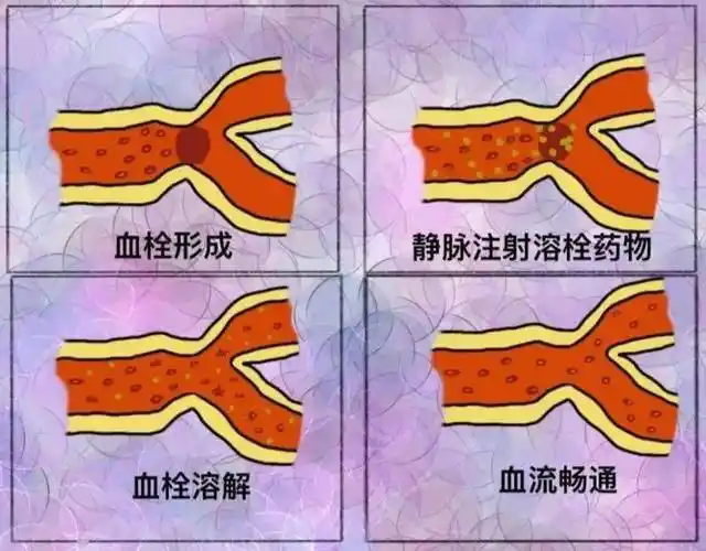 2,"黄金"六小时急性缺血性脑卒中静脉溶栓,血管内介入治疗的时间窗为6