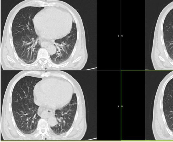 食管裂孔疝ct表现