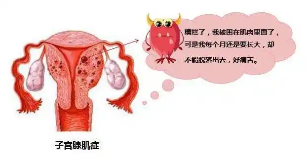 子宫腺肌症是由于患者子宫内膜异位增生并侵入到子宫肌层内生长所引起