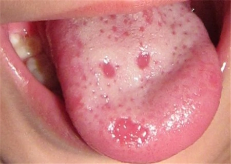 宝宝舌头起泡是怎么回事