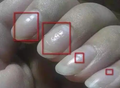 指甲出现这4种竖纹要当心——可能是身体器官发生病变的预警