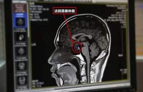 了解了他的病史,得知他在四年前体检时,头部磁共振提示"垂体良性肿瘤"