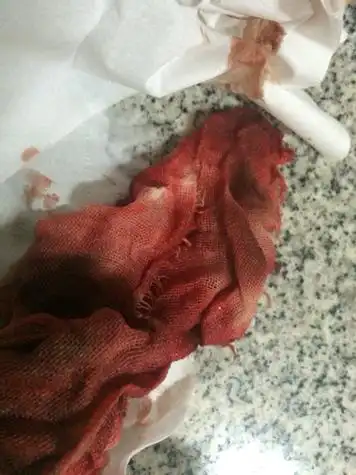 结果今天竟然在下面拉出两条沾满鲜血的纱布!这是为什么?