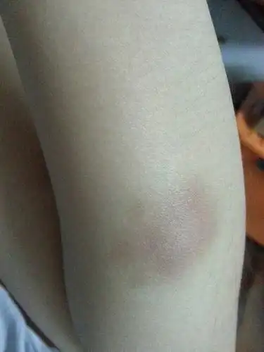 昨天中午突然发现胳膊上青了,也没撞到哪里,今天就