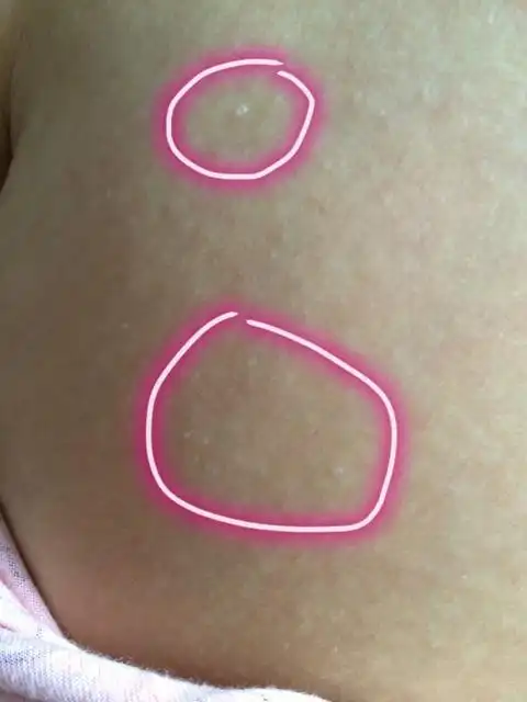 正在坐月子第15天,腿上和胳膊上长了很多透明小水泡,不知是什么.