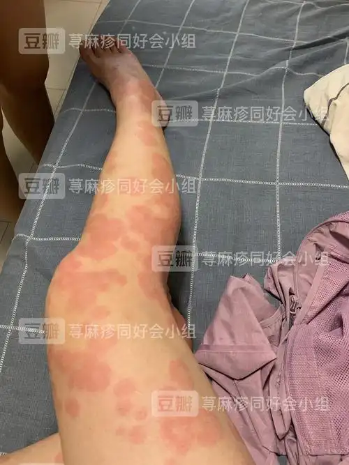 荨麻疹性血管炎!慎入