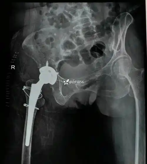 3贴膏药包治股骨颈骨折?一个月没好还让再贴一月,匪夷所思!