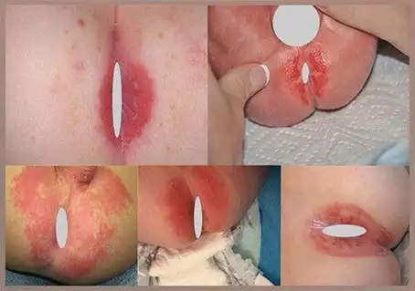 肛门湿疹图片肛门周边红色湿疹图片