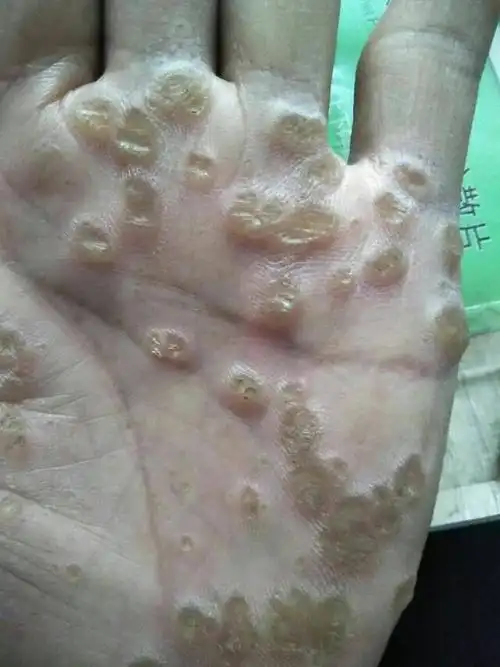 点状掌跖角化病