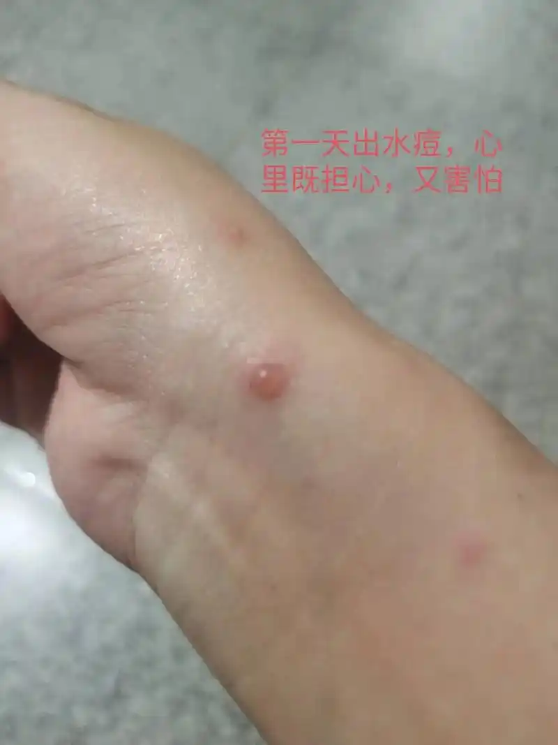 居家隔离抗痘…… 反复5天高烧39,出水痘第7天. 医生每次 - 抖音