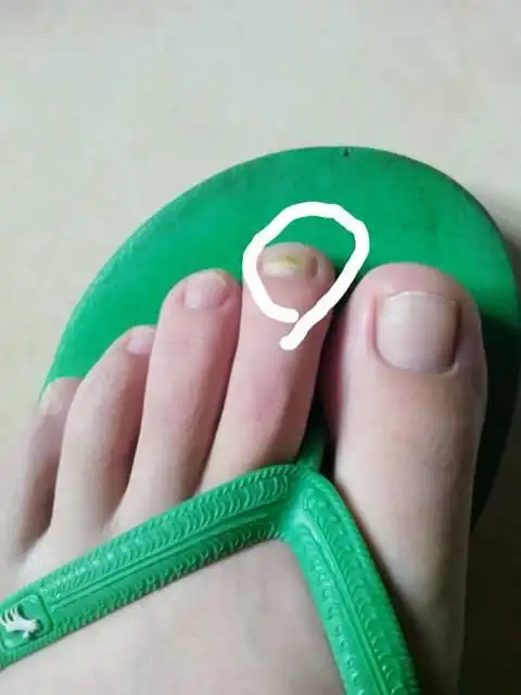 我的脚趾甲变成这个样了!是什么来的?我该怎么办?