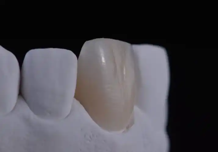 单颗变色前牙更有难度,漂白后做的全瓷冠修复,完全看_圈子-新氧美容