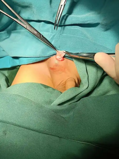 太和县人民医院疝气专科 微创,快速治愈小儿疝气,不住院,不拆线,花费