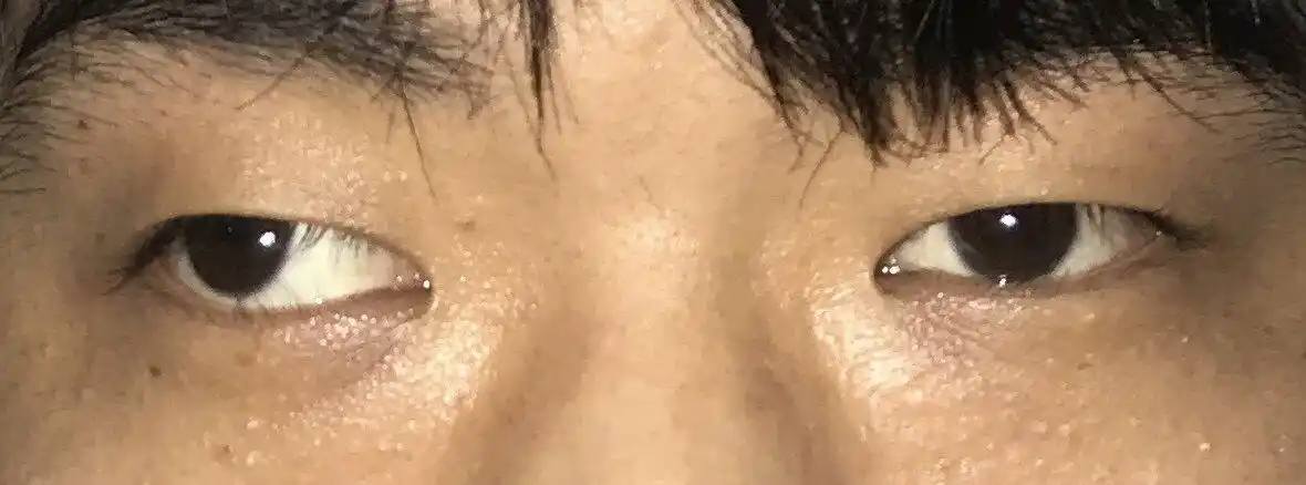 斜视_斜视_斜视症状表现 - 好大夫在线