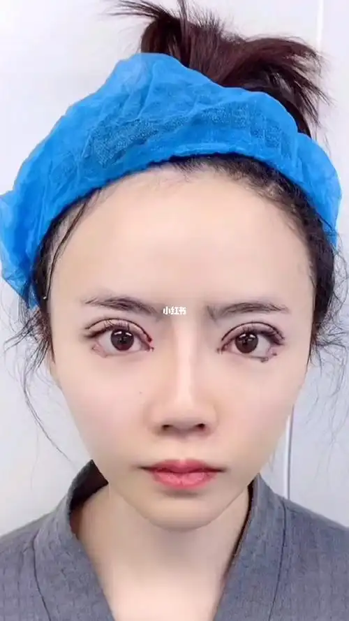 眼综合术后即刻_双眼皮_眼综合_美妆_医美整形