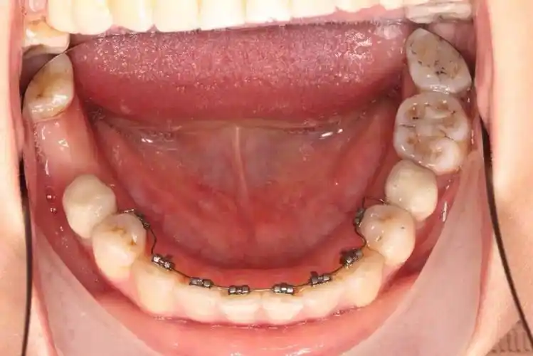 万巨口腔又引进矫正新技术舌侧2d矫正技术完美的隐形效果强感谢北京