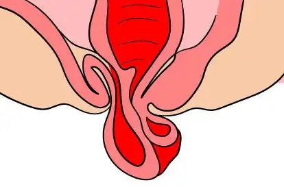 女性痔疮脱肛图片