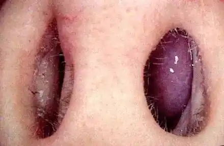 诊断出其他疾病如慢性鼻窦炎或鼻息肉,或诊断仍不明确时应该常规地往