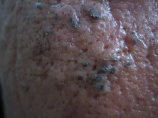 结节性类弹力纤维病