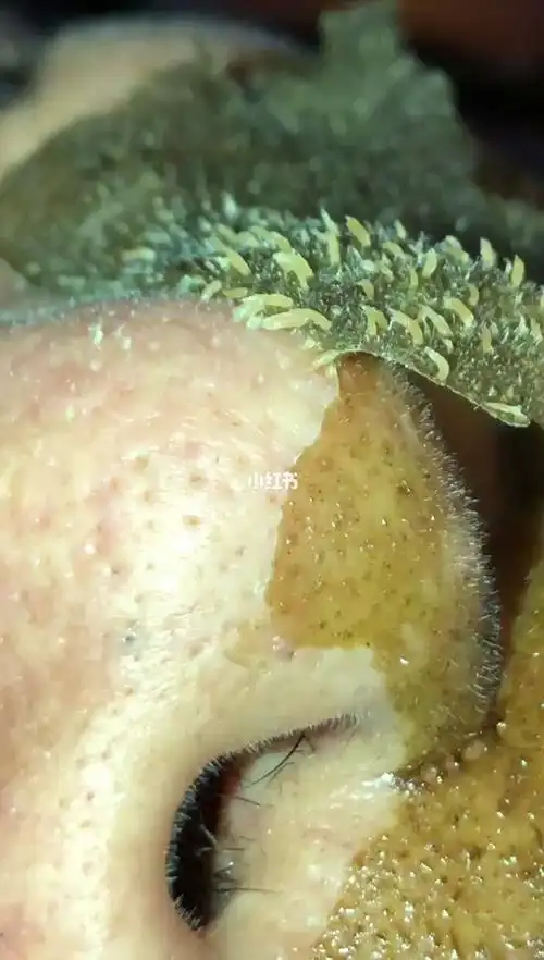 鼻子密密麻麻的黑头粉刺连根拔起