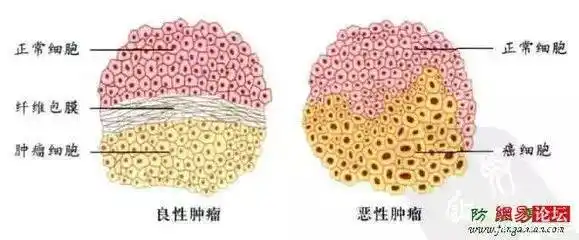 【病理知识】良性肿瘤与恶性肿瘤