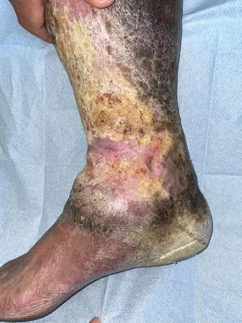 慢性伤口的胜利:愈合背后的挑战与希望|手术|创面|治疗|口腔溃疡_网易