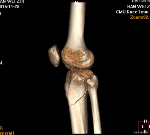 左胫骨近端骨折