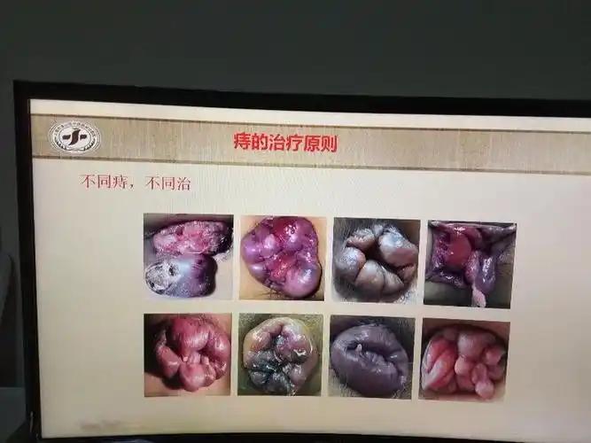 痔疮的形态多种多样因此治疗方法也不尽相同